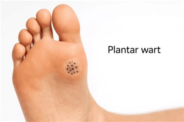 Are plantar warts HPV?