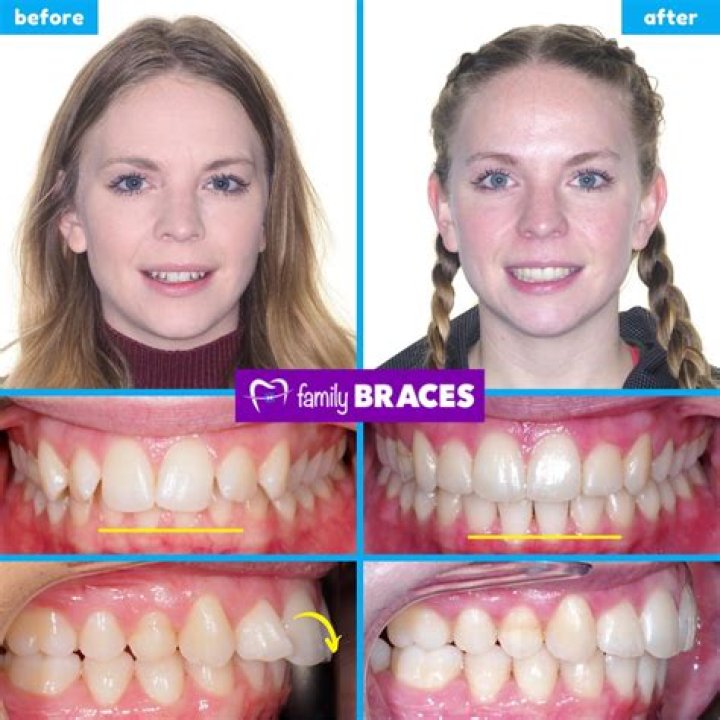 Can I bite with my front teeth with braces?