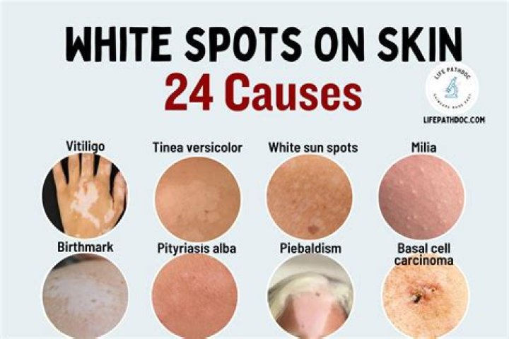 How do you get white scars on Repigment?