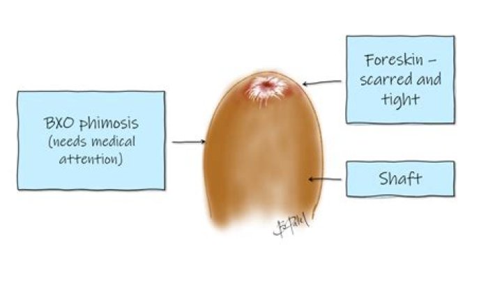 How do you open a tight foreskin?