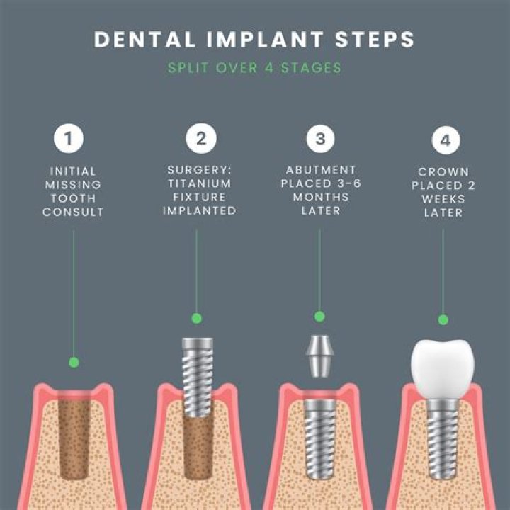 How long after tooth pulled can you get implant?
