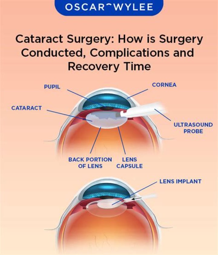How much time does cataract surgery take?