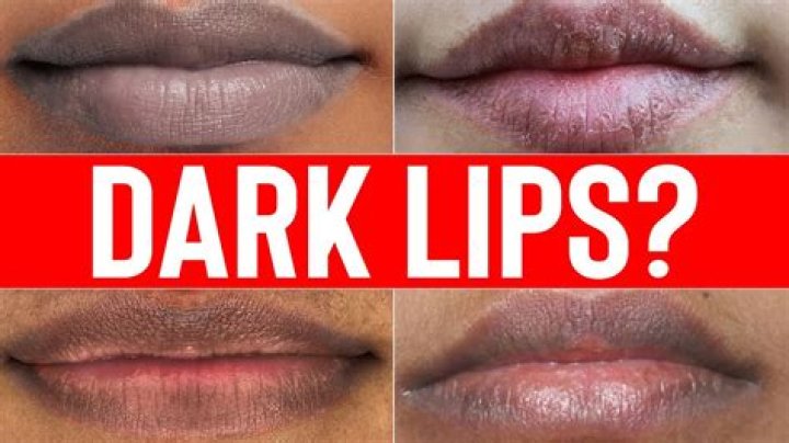 Why is my top lip dark?